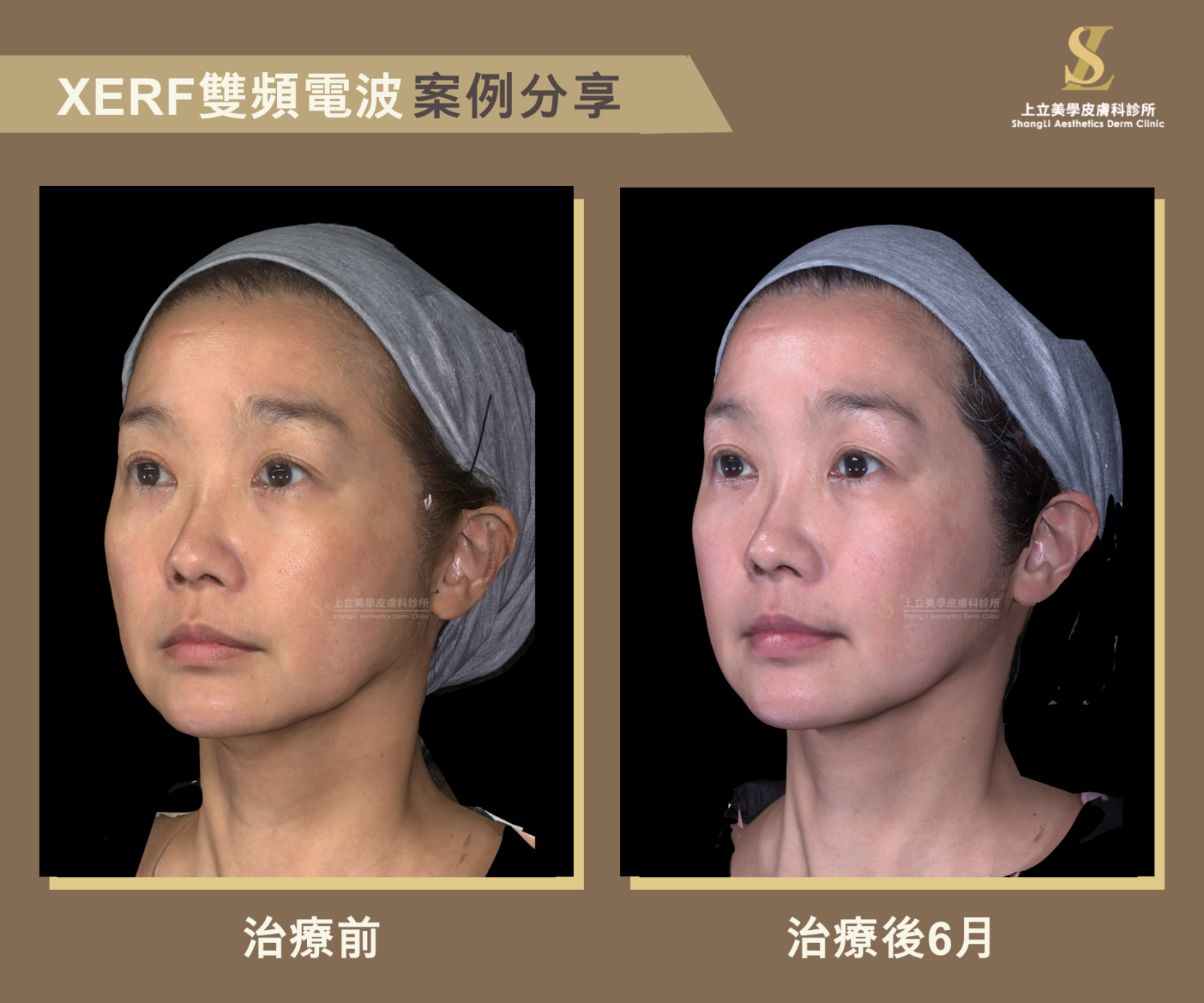 上立醫師案例，用XERF雙頻電波治療後6個月可見，整體輪廓往內收緊、下顎線條也緊實俐落不