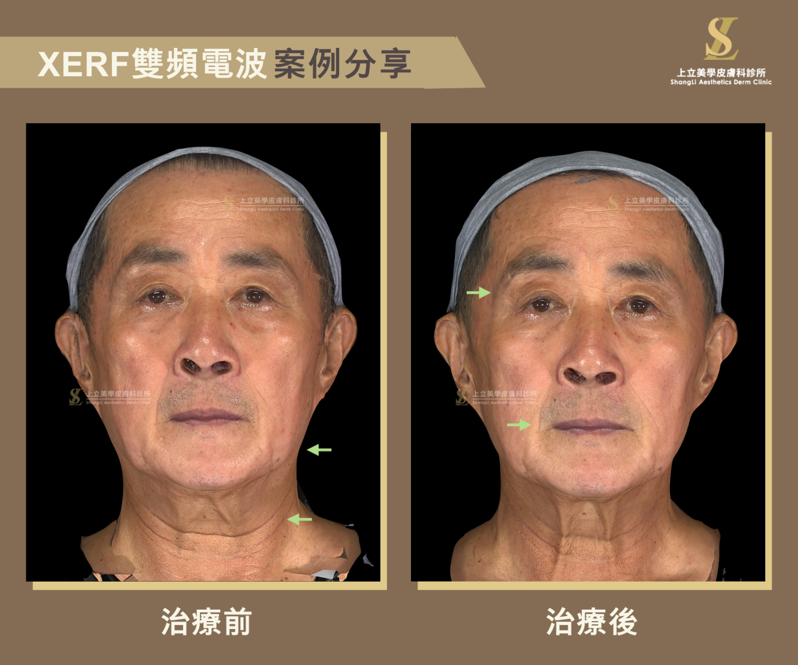 上立醫師選擇XERF雙頻電波治療，全臉600發，可見中下臉的鬆弛下垂明顯緊實、下顎線與頸部線條變得俐落，整體臉部輪廓也更為提升