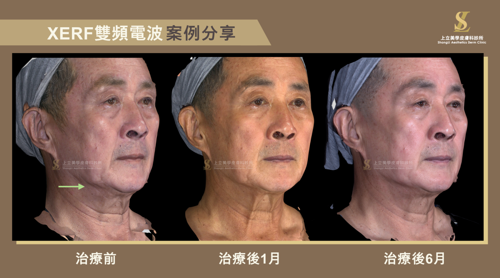 上立醫師選擇XERF雙頻電波治療，全臉600發