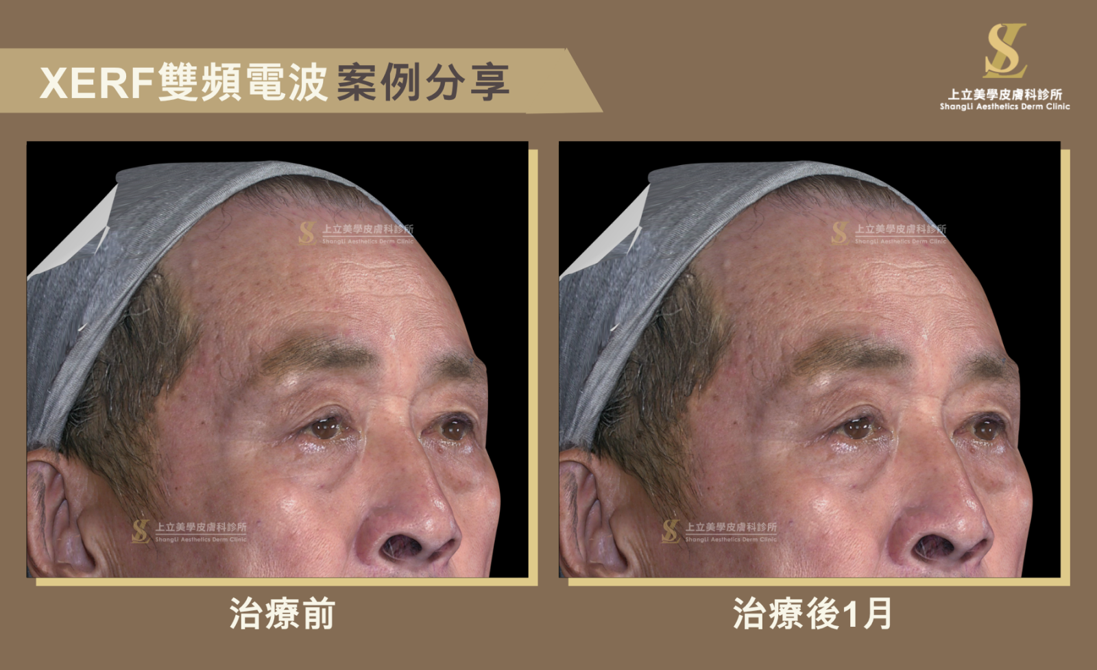 上立醫師選擇XERF雙頻電波治療，全臉600發，整體臉部輪廓更緊緻
