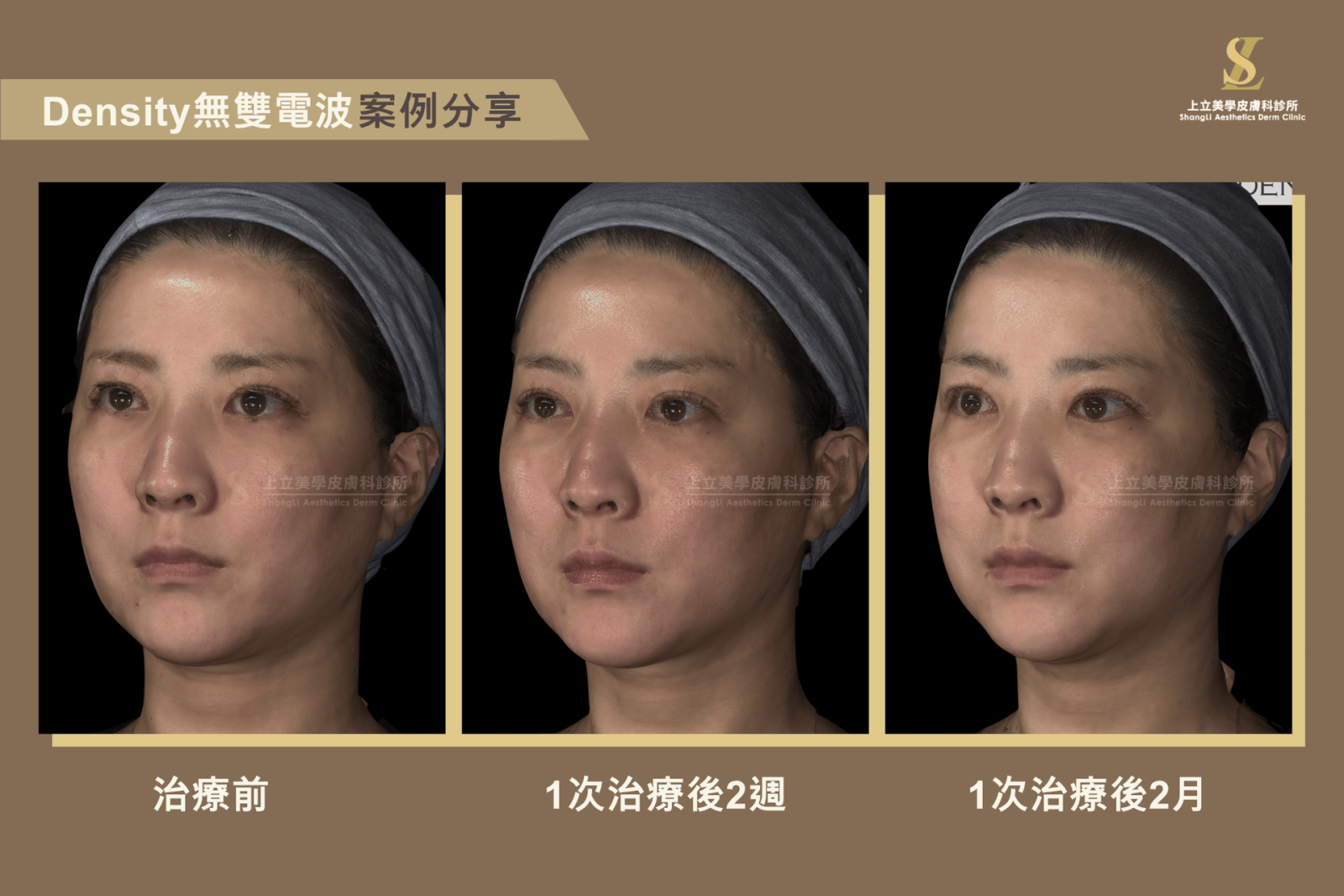 上立美學皮膚科_無雙電波_案例