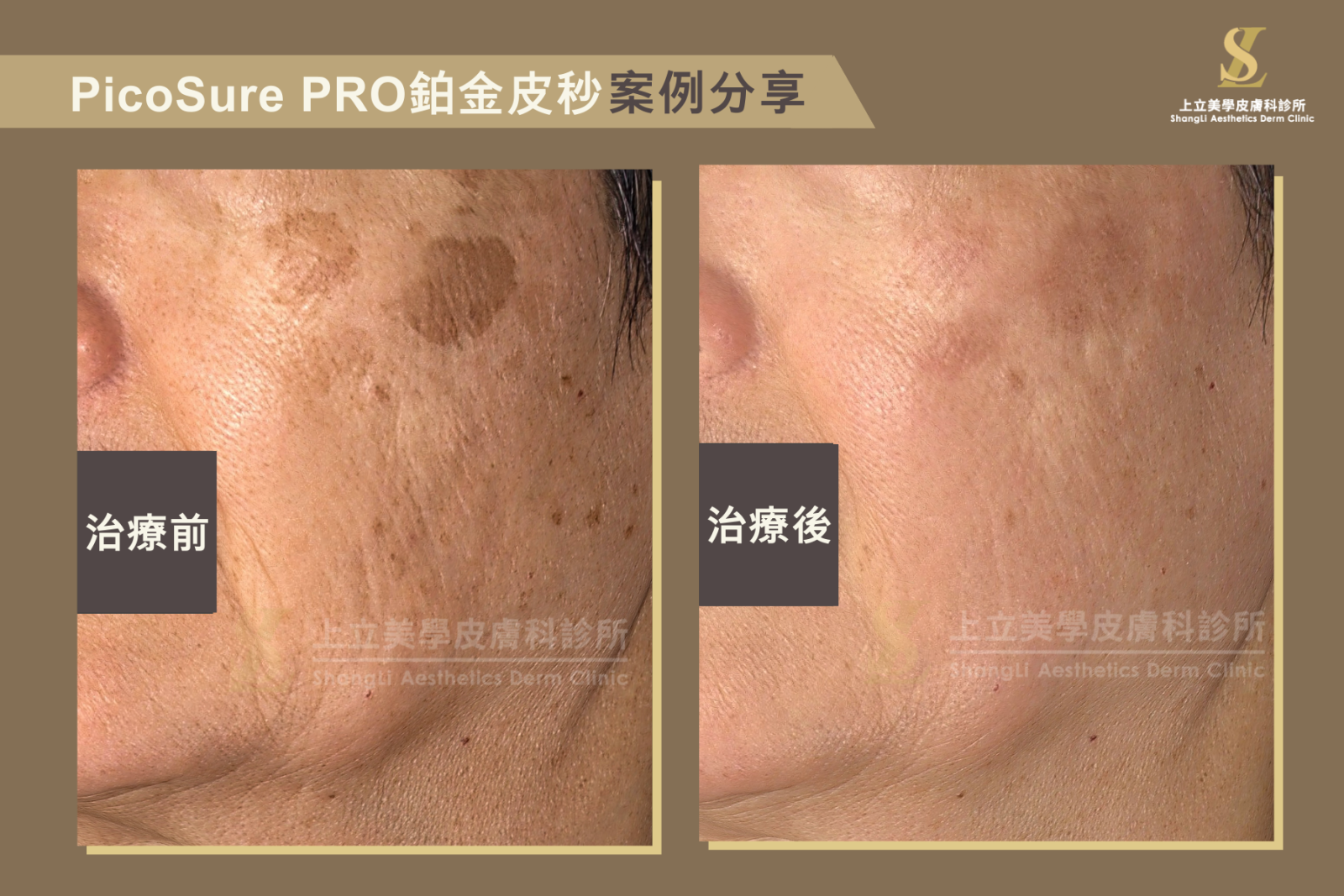 PicoSure Pro鉑金皮秒雷射治療效果