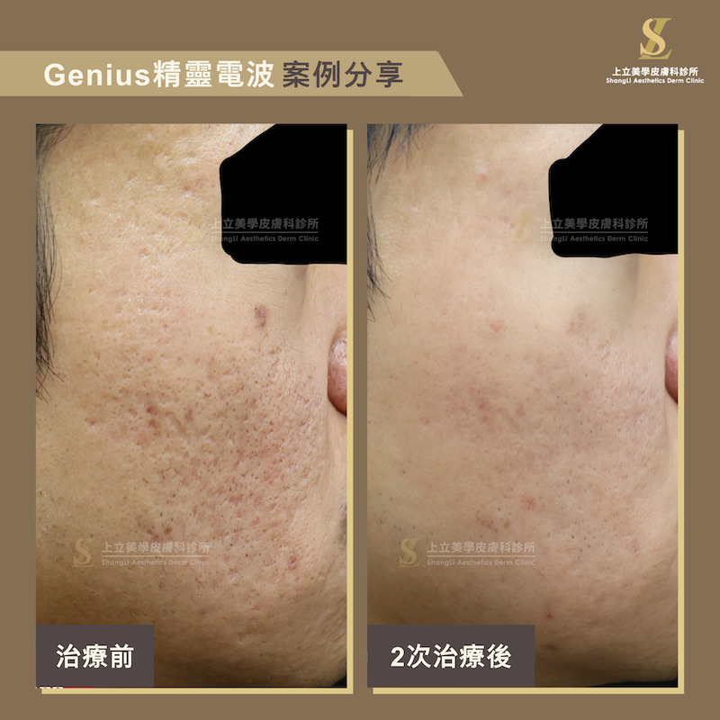 Genius精靈電波同步改善泛紅痘疤與凹疤