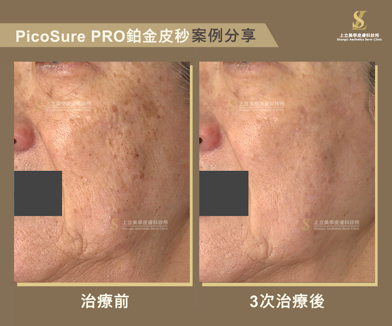 PicoSure PRO鉑金蜂巢皮秒,快速掃除斑點暗沉、細緻膚質